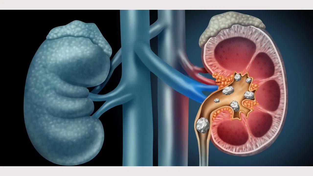 मानव शरीर का महत्वपूर्ण अंग है किडनी, क्या है किडनी के खराब होने के मुख्य कारण? आइये जानें
