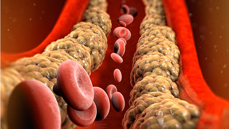 Cholesterol is becoming forgetful: AIIMS reveals