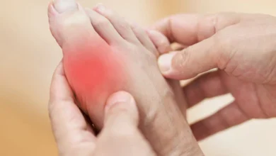 Control Uric Acid naturally in 1 month, follow these 7 effective tips