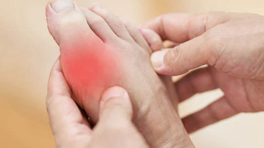 Control Uric Acid naturally in 1 month, follow these 7 effective tips