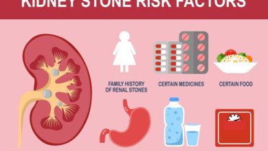 Kidney Stone Symptoms and Risks: Recognize the Signs and Avoid These Causes