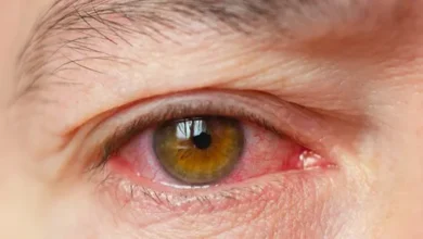Dry eyes? Do these 5 things before taking medicine, get relief