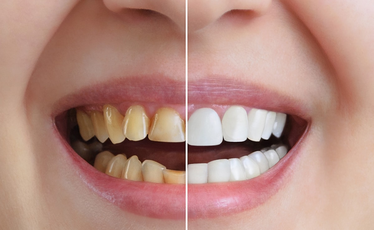 Get rid of pyorrhea and cavities: Adopt oil pulling and get pearly white teeth